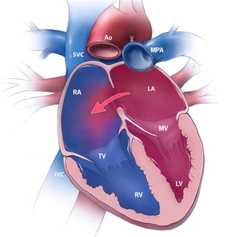 Atrial Septal Defect Complications
