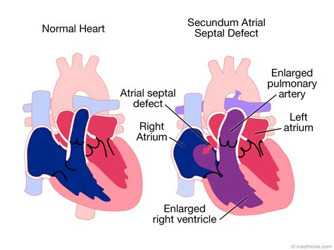 Atrial Septal Defect FAQs