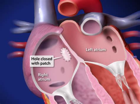 Atrial Septal Defect Repair