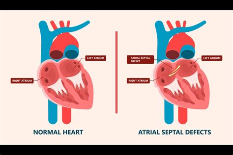 Atrial Septal Defect Symptoms