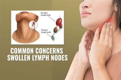 Autoimmune Disorders and Lymph Node Swelling