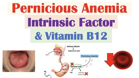 B12 Deficiency Anemia Causes