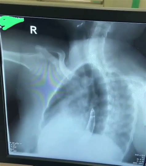 Barium Swallow