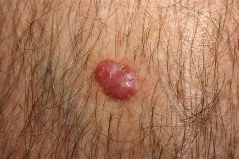 Basal Cell Carcinoma