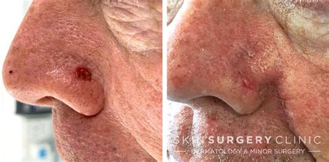Basal Cell Removal