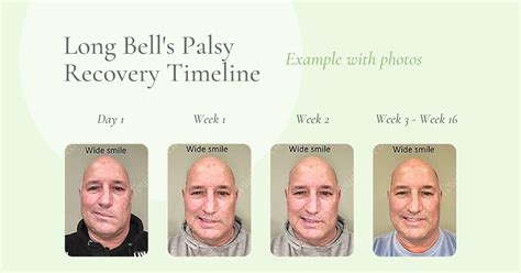 Bell Palsy Recovery