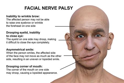 Bell Palsy Symptoms