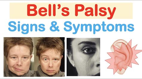 Bell's Palsy Symptoms