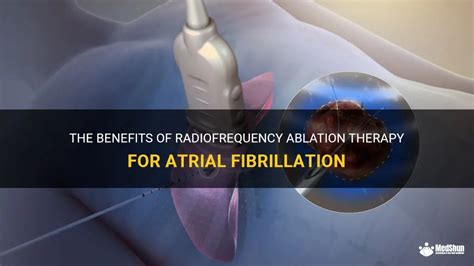 Benefits Of Ablation Therapy