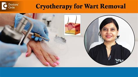 Benefits Of Cryotherapy For Warts Removal