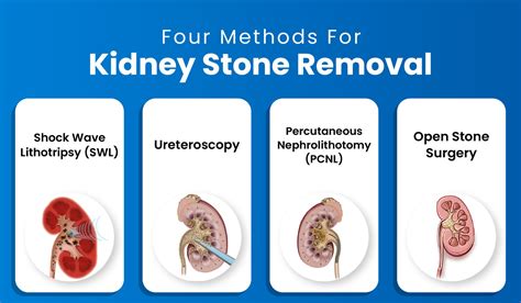 Benefits of Kidney Stone Surgery