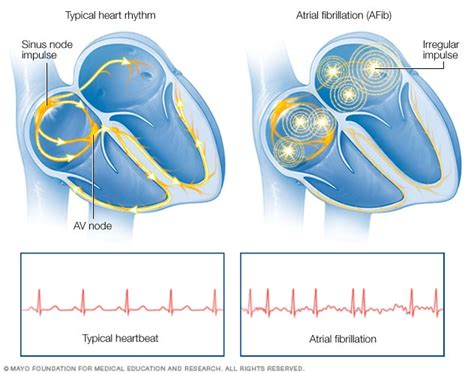 Benefits of Atrial Fibrillation Ablation