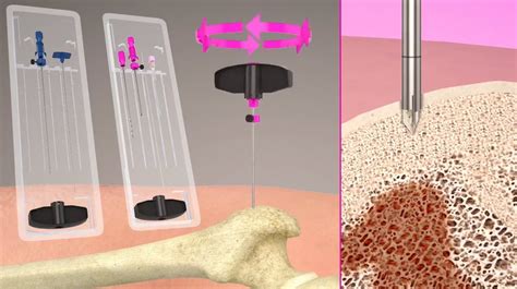 Benefits of Bone Biopsy