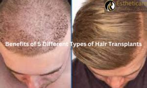 Benefits of Hair Replacement Surgery