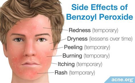 Benzoyl Peroxide 5 Acne Treatment Side Effects