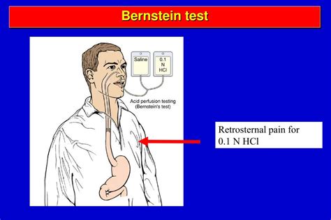 Bernstein Test