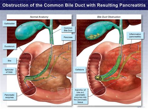 Bile Duct Obstruction