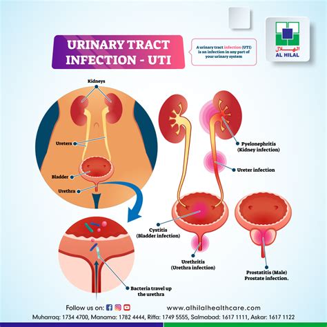 Bladder Infection