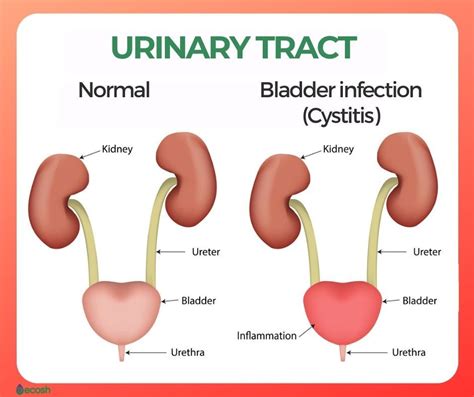 Bladder Infection Conclusion