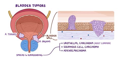 Bladder Tumors