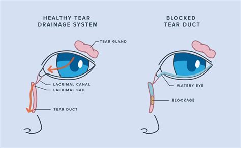 Blocked Tear Duct