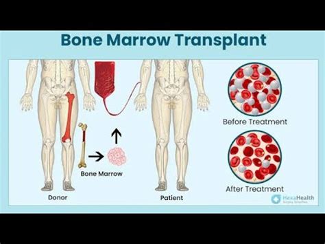 Bone Marrow Risks