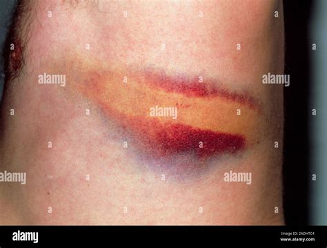Broken Rib Bruise