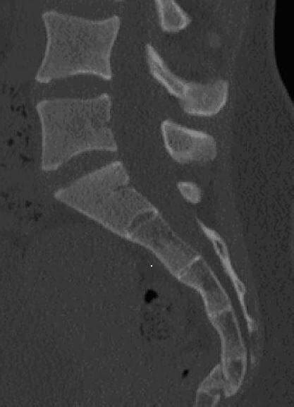 Bruised Tailbone Prognosis