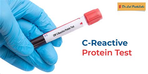 C Reactive Protein Test