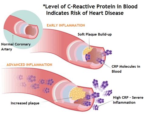 CRP Cardiovascular Disease