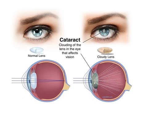 Cataract Surgery Recovery