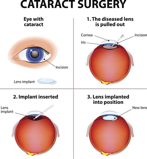 Cataract Treatment Options