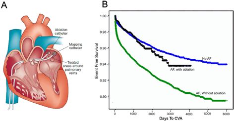Benefits of Catheter Ablation