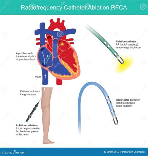 Catheter Ablation Procedure