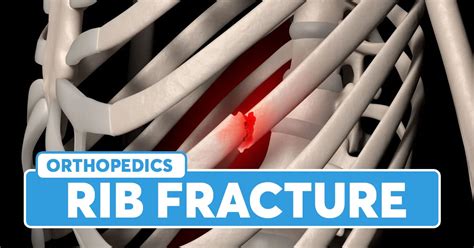 Causes and Risk Factors of Bruised Ribs