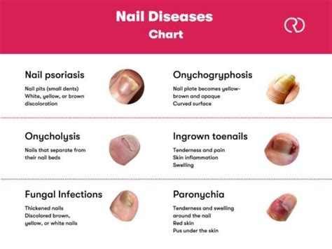 Causes of Fingernail Loss