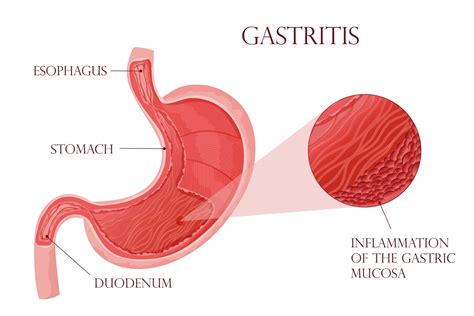 Causes of Gastritis