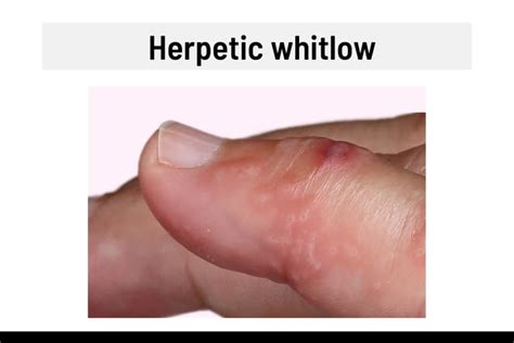 Causes of Herpes on Finger