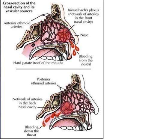 Causes of Posterior Nosebleeds