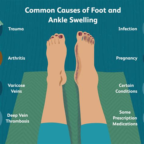 Causes of Swollen Ankles During Pregnancy