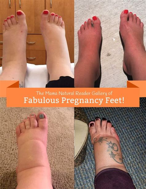 Causes of Swollen Feet During Pregnancy