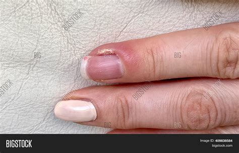 Causes of Swollen Finger Around Nail