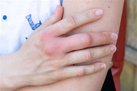 Causes of Swollen Finger Joint Pain