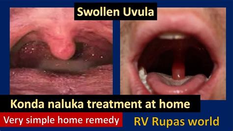 Causes of a Swollen Uvula