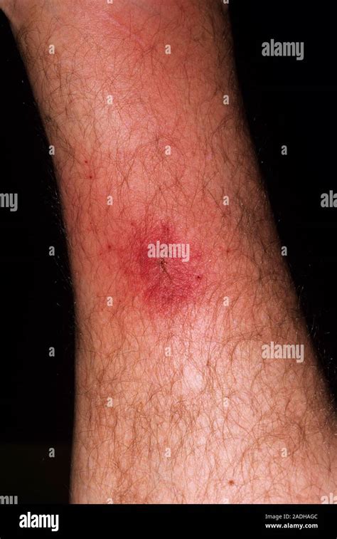Cellulitis from insect bites