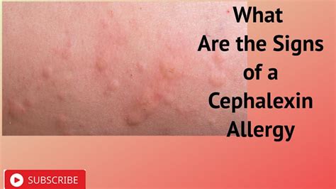 Cephalexin Skin Infections