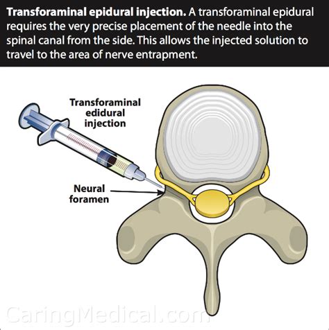 Cervical Epidural Steroid Injection Procedure