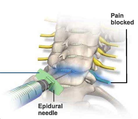 Cervical Epidural Steroid Injection Effectiveness
