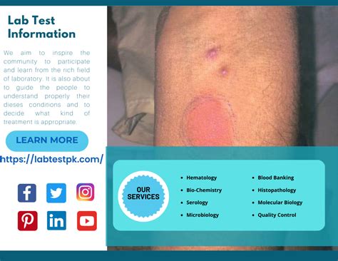 Challenges in Reading Mantoux Test