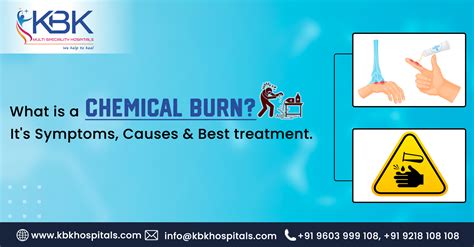 Chemical Burn Support and Resources